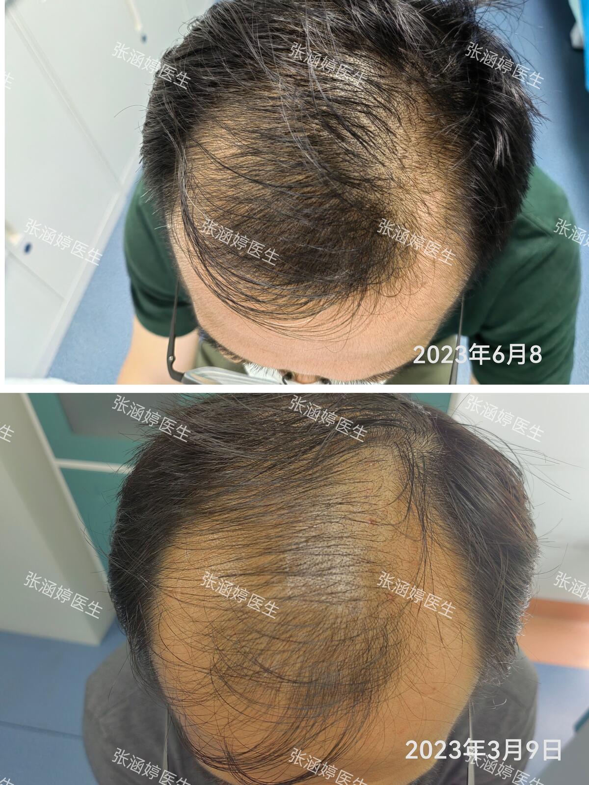 最新脫發技術，探索治療脫發的新途徑
