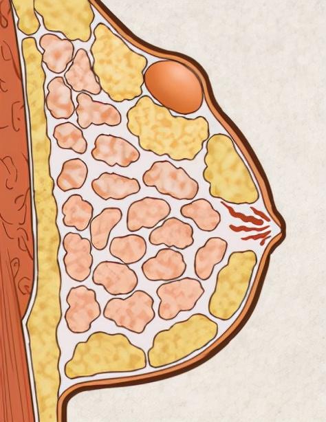 最新乳腺分型研究，探索乳腺癌診療的新領域